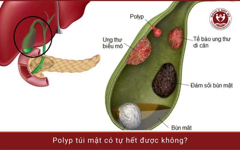 POLYP RỐN CÓ TỰ HẾT KHÔNG